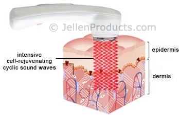 How Ultrasonic Facial Toning Works