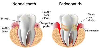 Periodontitis is a cause of sensitive teeth